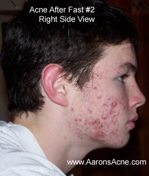 Worse Acne