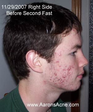 Severe Acne Images